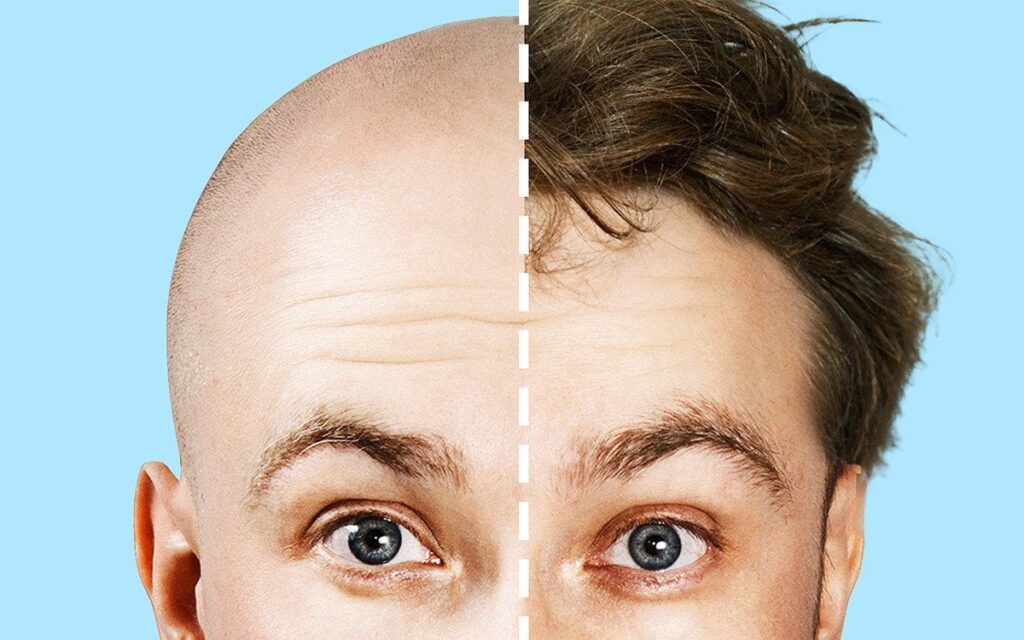Reversing Balding with Proven Methods