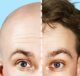 Balding with Proven Methods